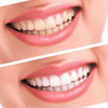 NOW TEETH WHITENING CHANGES FOREVER - Wolrdiscounts